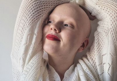 Maïwenn, atteinte de pelade : « J'ai toujours su que je terminerai chauve »