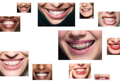Dents parfaites : ce qu'il faut savoir sur les traitements...et leurs arnaques