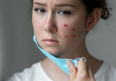 Avec la pandémie, les jeunes souffrent davantage de problèmes de peau
