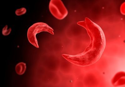 Le dépistage de la drépanocytose bientôt généralisé ?