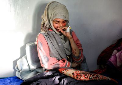Yémen : qui est Al-Anoud Hussein Chariane, défigurée à l'acide par son ancien mari ?