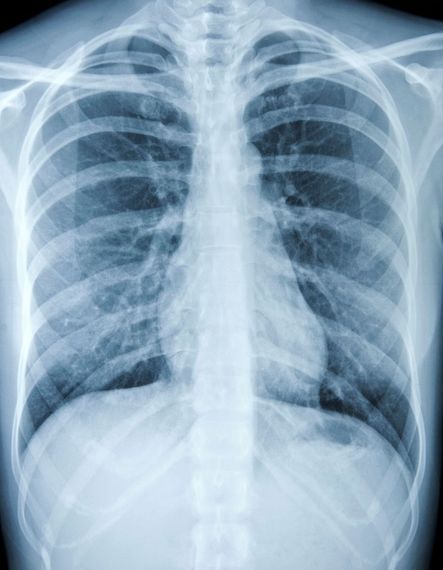 183 Maladie des os fantômes : « Je vis avec un poumon et une partie de ma cage thoracique en moins »