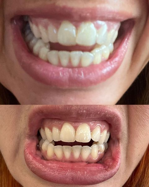 Les gouttières dentaires : bonne ou mauvaise idée ? - Magazine