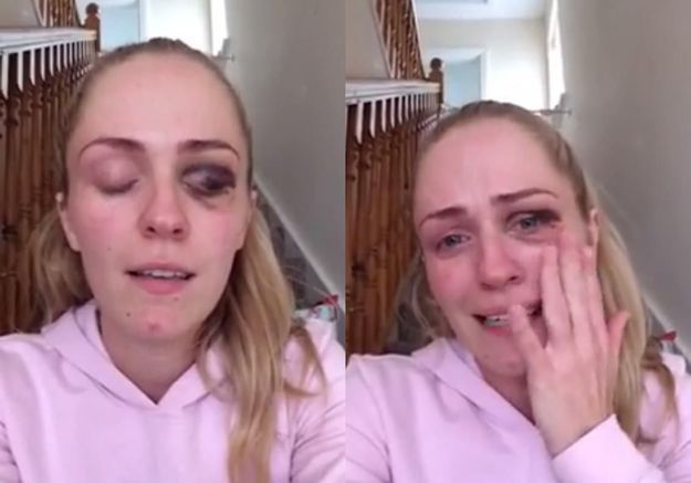 Une blogueuse dénonce les violences conjugales en montrant son visage tuméfié