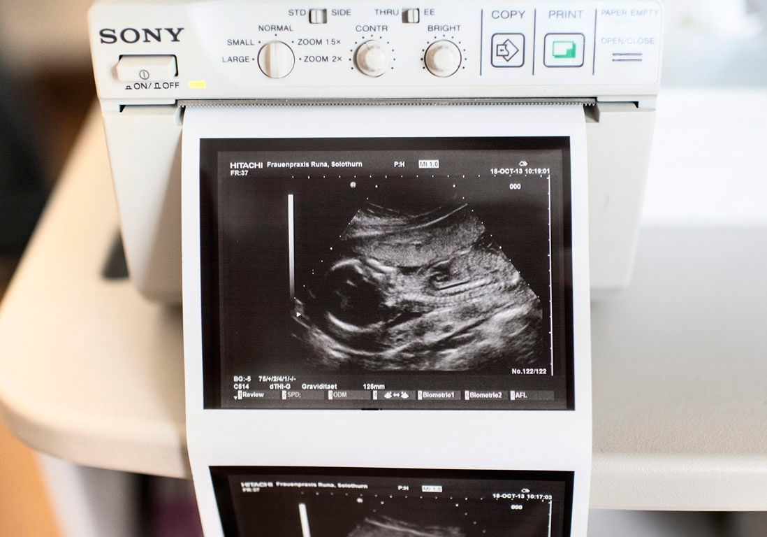 Une Indienne Garde Un Fœtus Dans Son Corps Pendant 36 Ans Elle