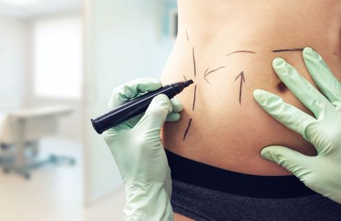 Avant/après liposuccion : Lucile, 32 ans, « je pleurais devant le miroir avant de m’habiller »