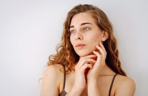 Taches post-acné : l’actif recommandé par un médecin esthétique pour retrouver un teint unifié